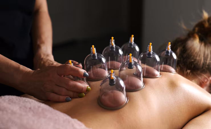 cupping